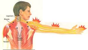 Carpel Tunnel Syndrome arm areas of pain relief offered by Chiropractors of San Diego Chiropractic Massage.