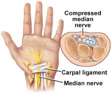 Carpel Tunnel Syndrome pain relief offered by Chiropractors of San Diego Chiropractic Massage.