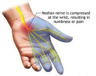 Arm and Palm Pain treatment by San Diego Chiropractic and Massage