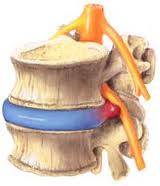 Image of herniated disc by chiropractors of San Diego Chiropractic and Massage